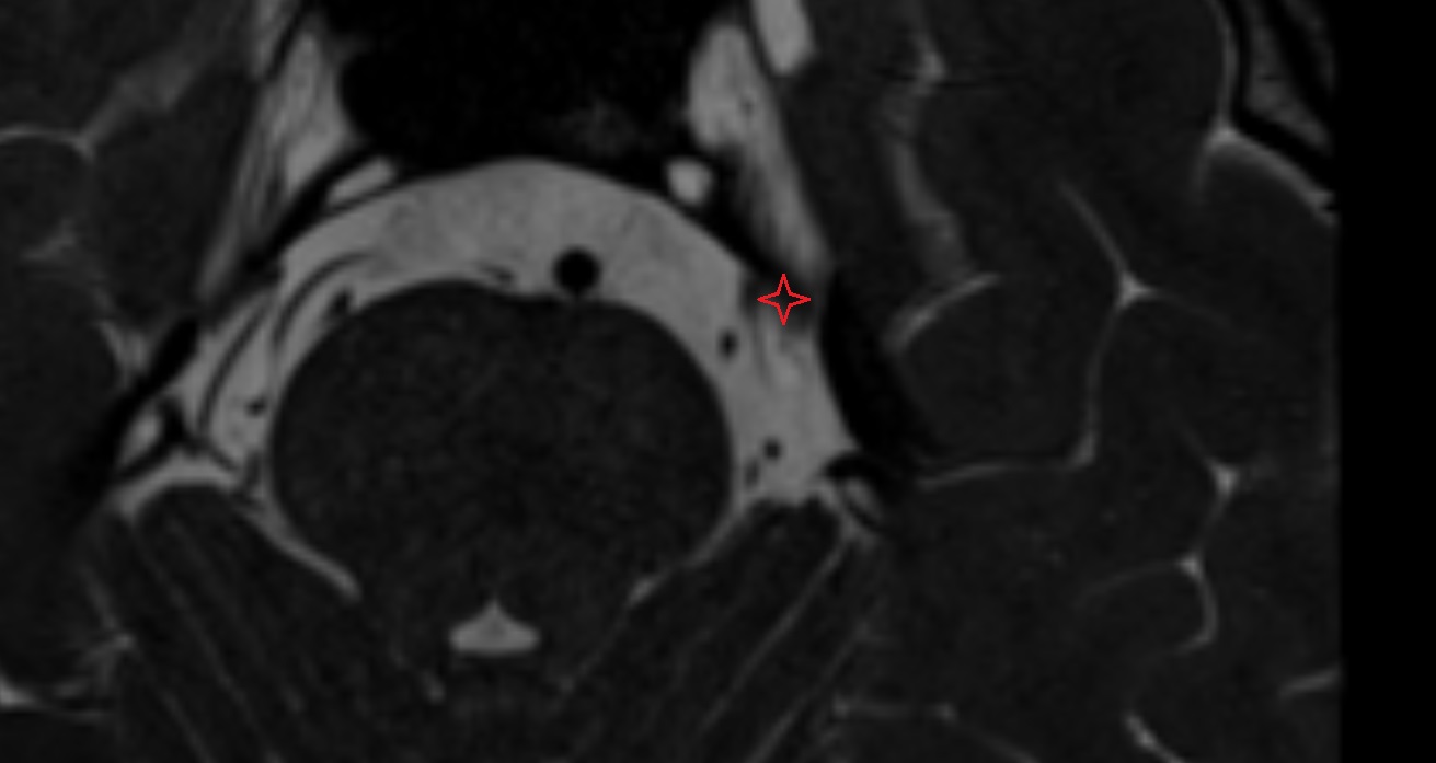 Trigeminal ganglion  MRI axial anatomy image -img-00001-00001