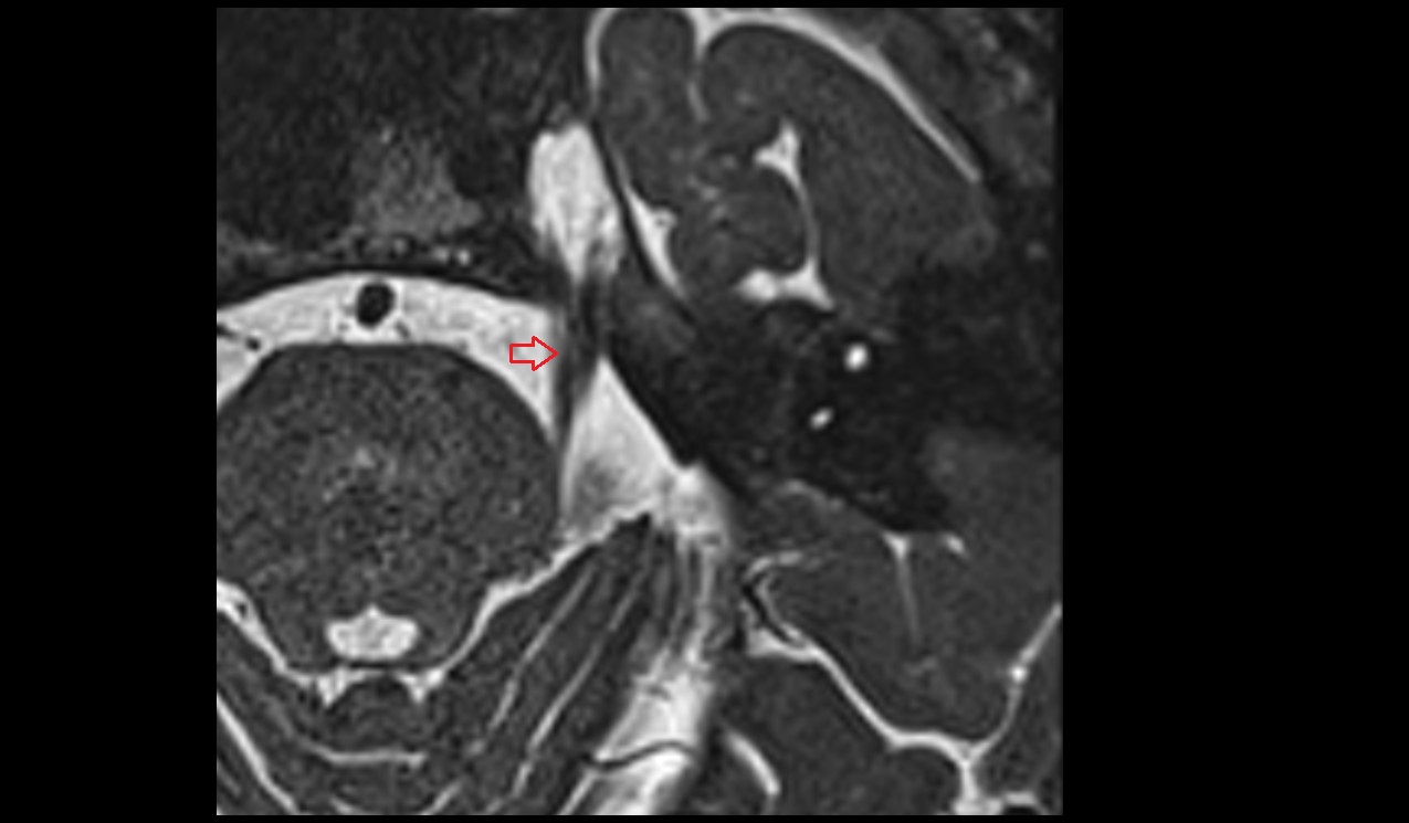 Trigeminal nerve (Cranial nerve V) 3T MRI axial image