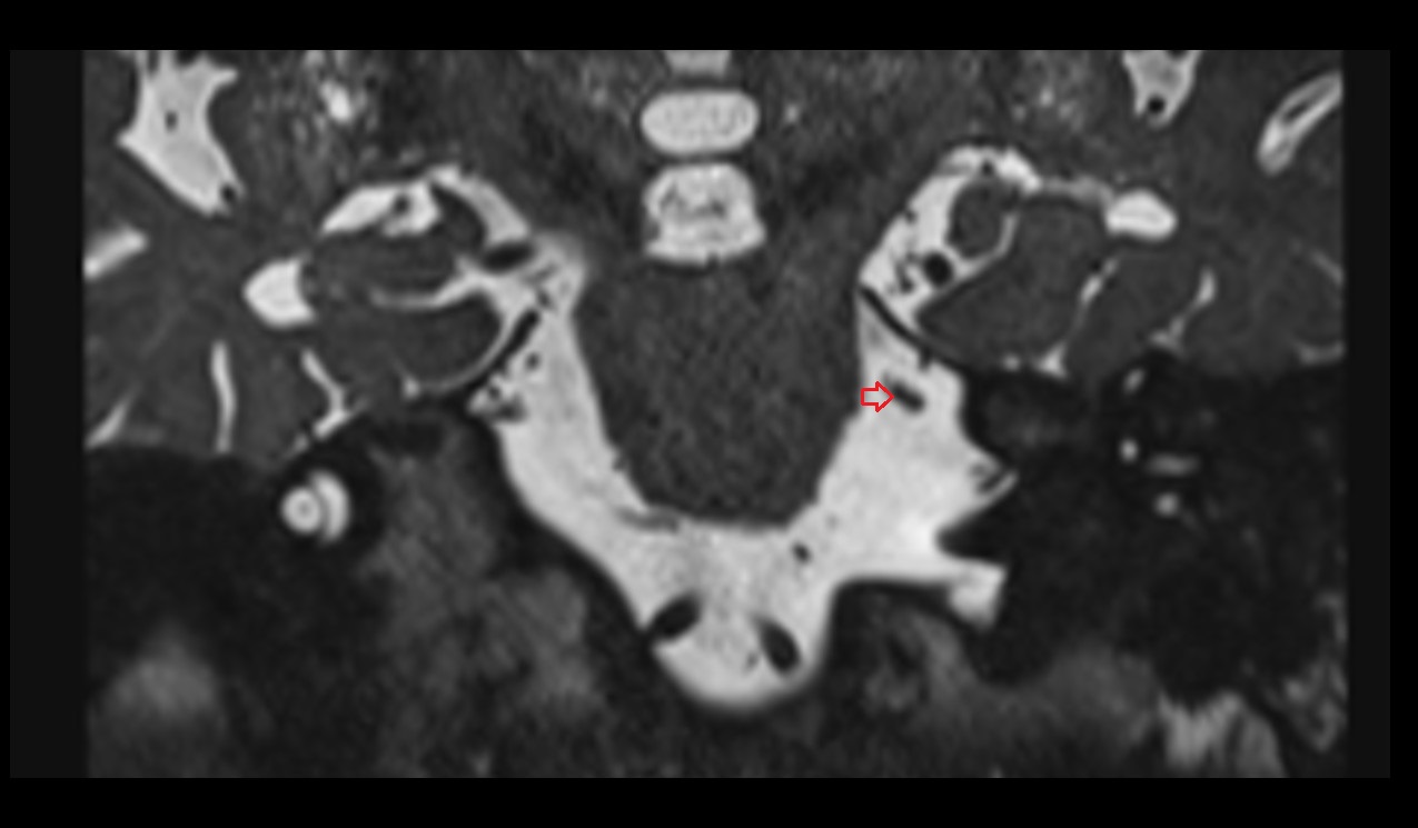 Trigeminal nerve (Cranial nerve V) 3T MRI coronal image