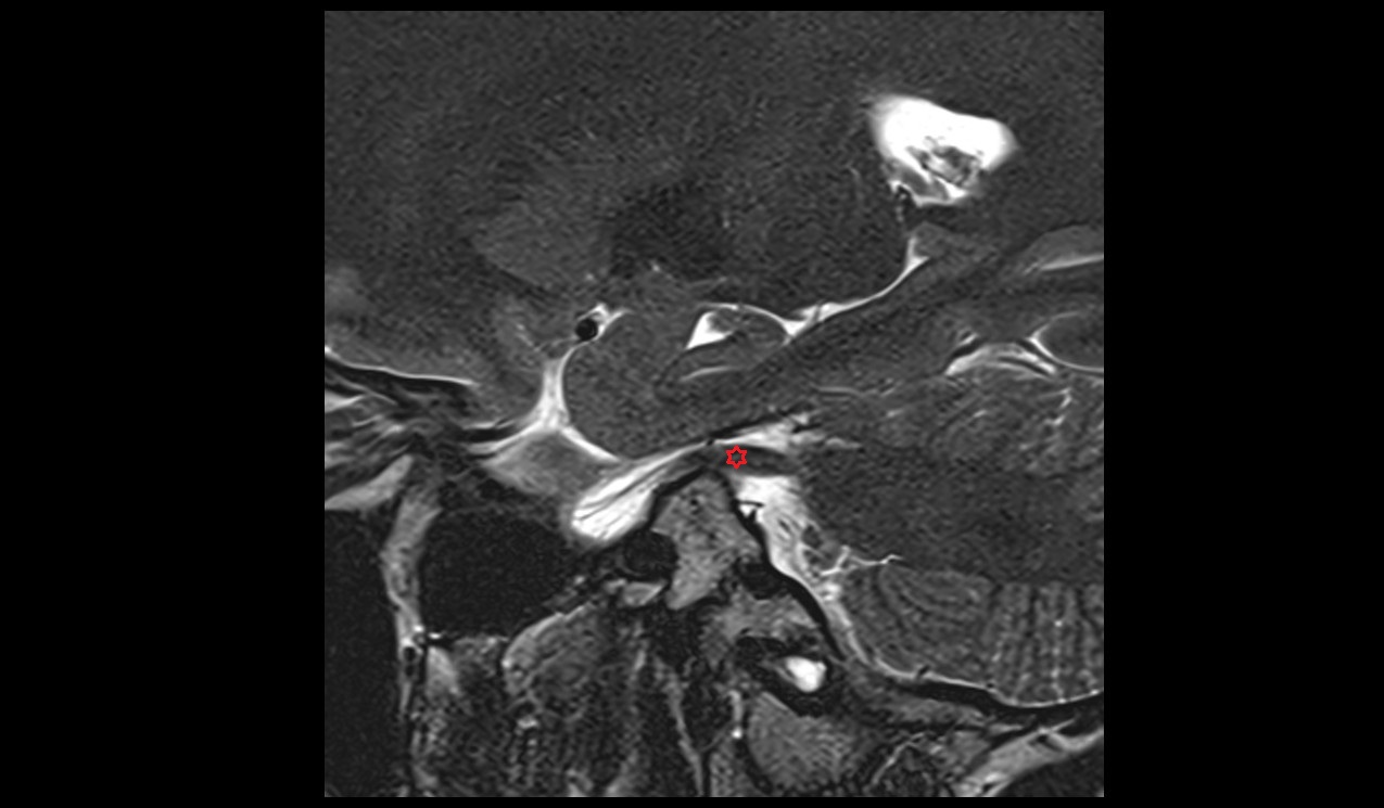 Trigeminal nerve (Cranial nerve V) 3T MRI sagittal image 1