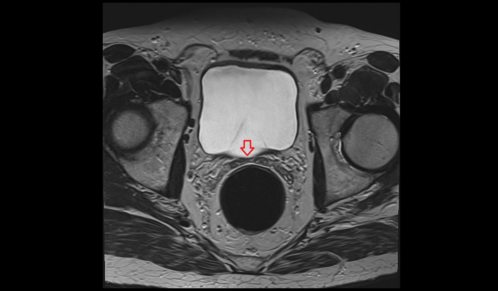 Trigone of bladder MRI