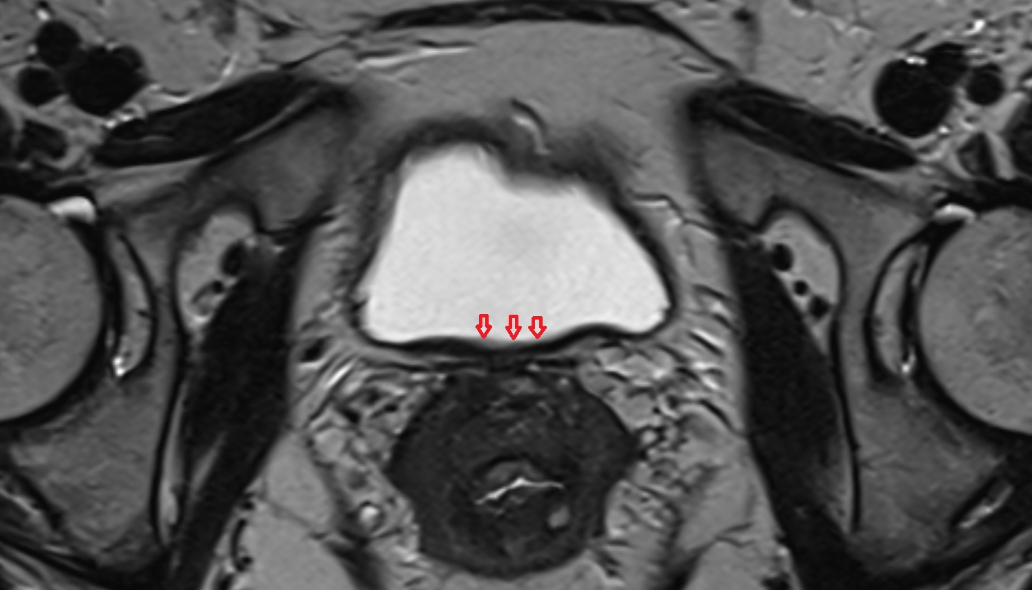 Trigone of urinary bladder MRI axial  anatomy  image-img-00000-00000