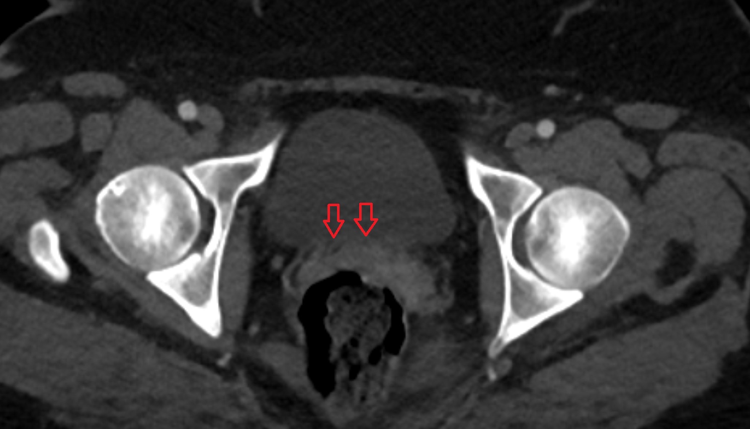 Trigone of urinary bladder ct  axial  anatomy  image-img-00000-00000