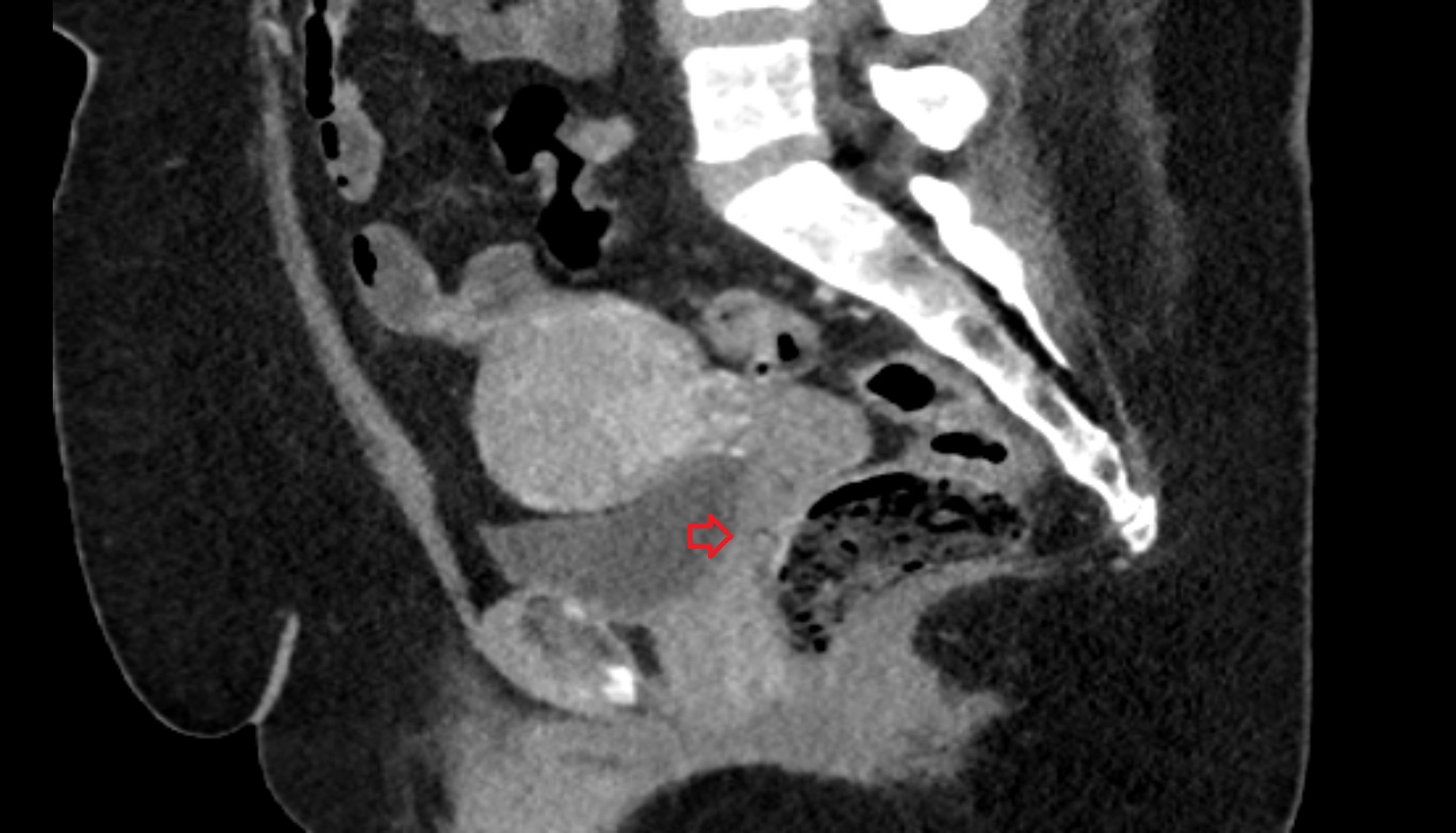Trigone of urinary bladder ct  sag  anatomy  image-img-00000-00000
