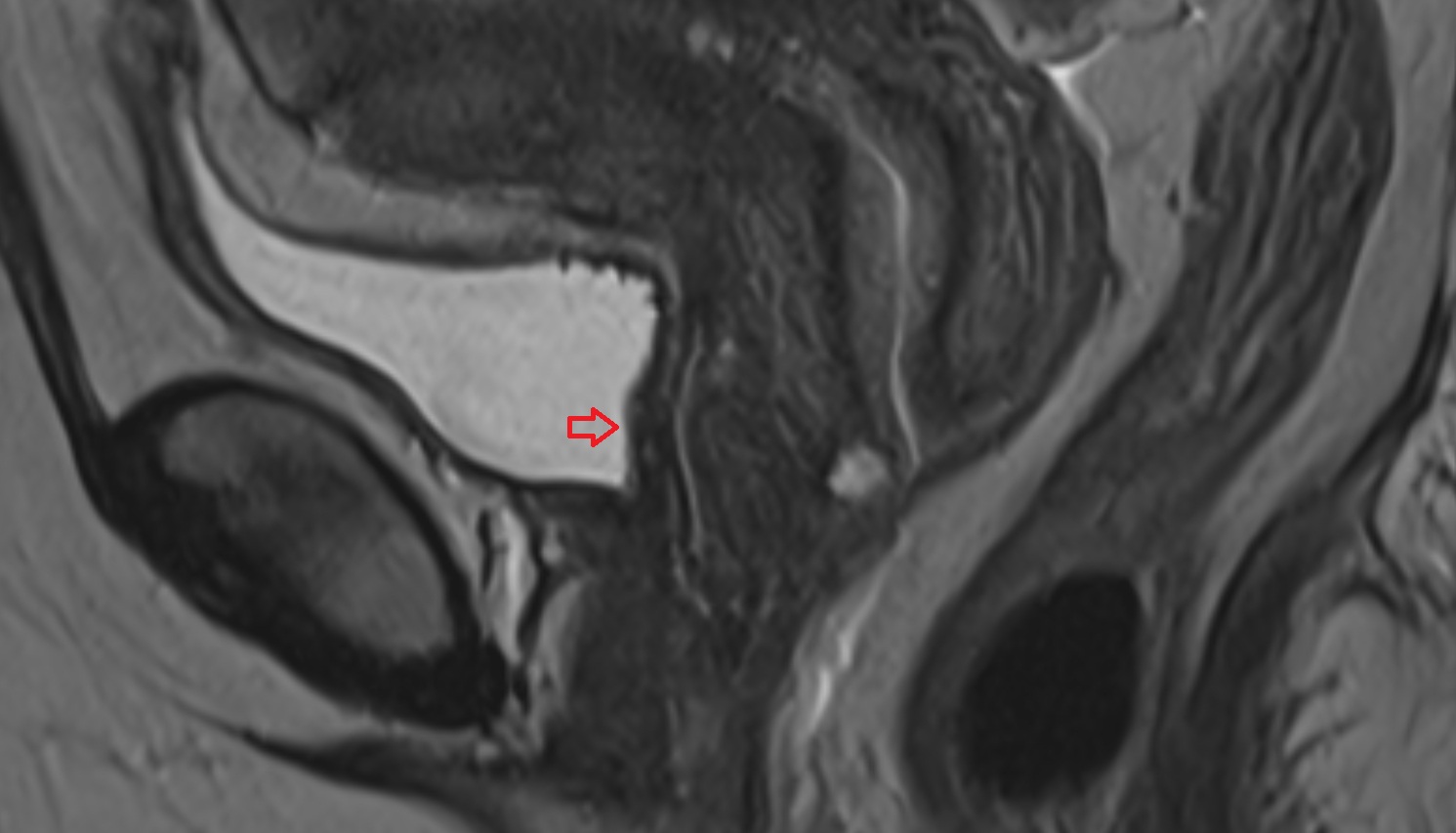 Trigone of urinary bladder mri  sag  anatomy  image-img-00000-00000