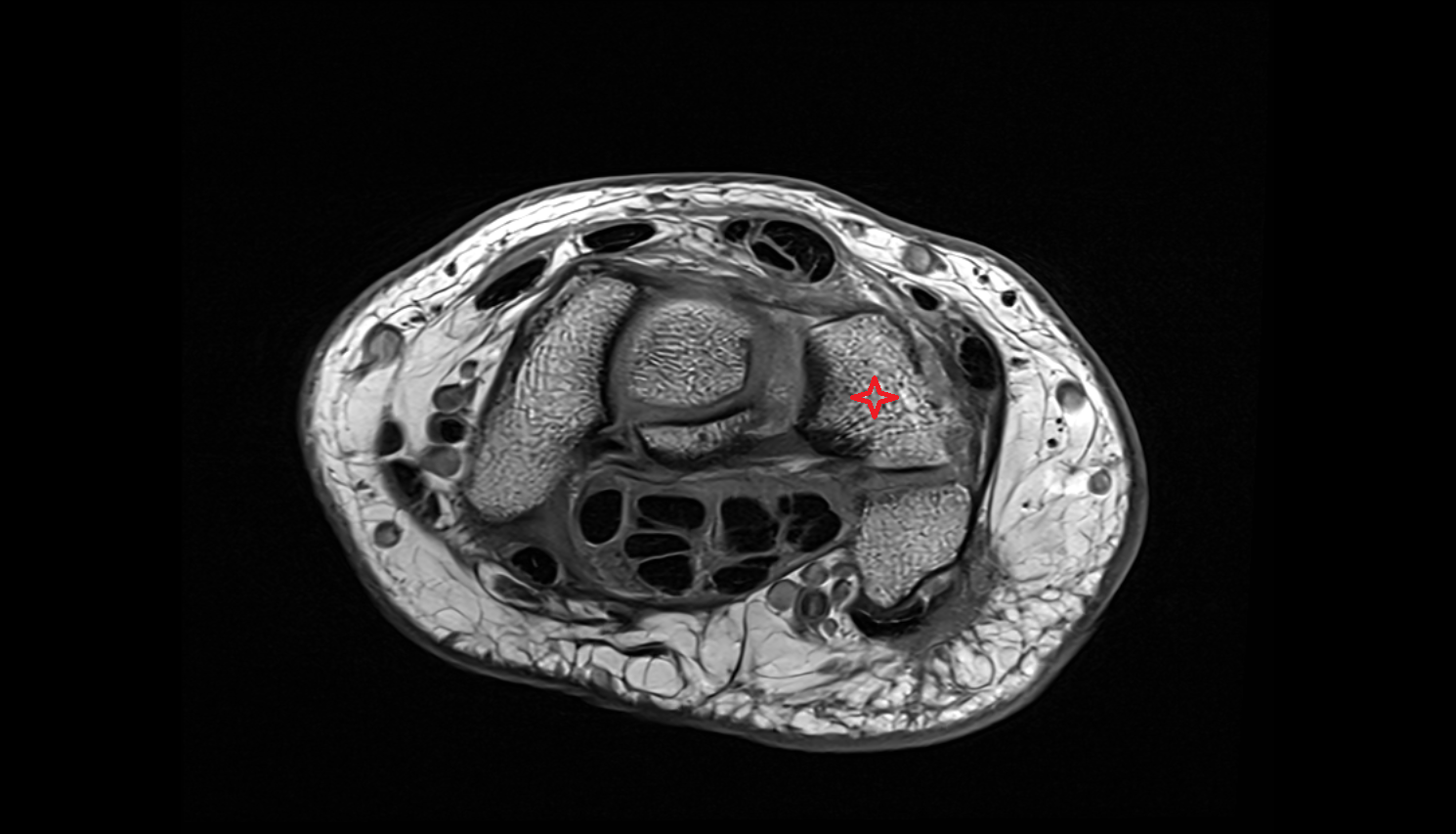 Triquetrum axial cross sectional anatomy 3T MRI AI enhanced radiology image-img-00000-00000