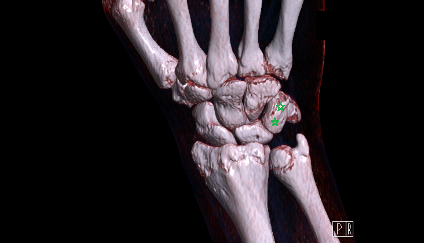Triquetrum bone CT 3D VRT image -img-00000-00000