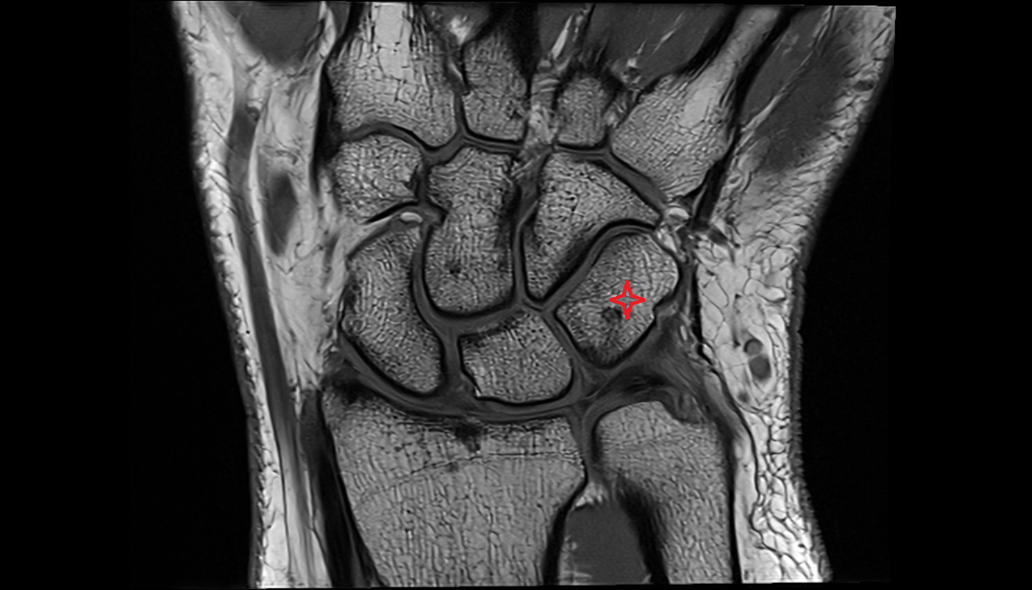 Triquetrum coronal cross sectional anatomy 3T MRI AI enhanced radiology image-img-00000-00000