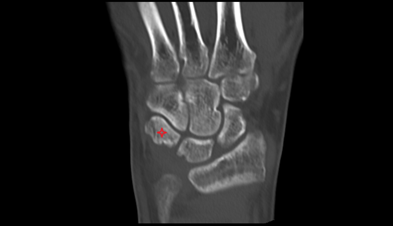 Triquetrum ct coronal image