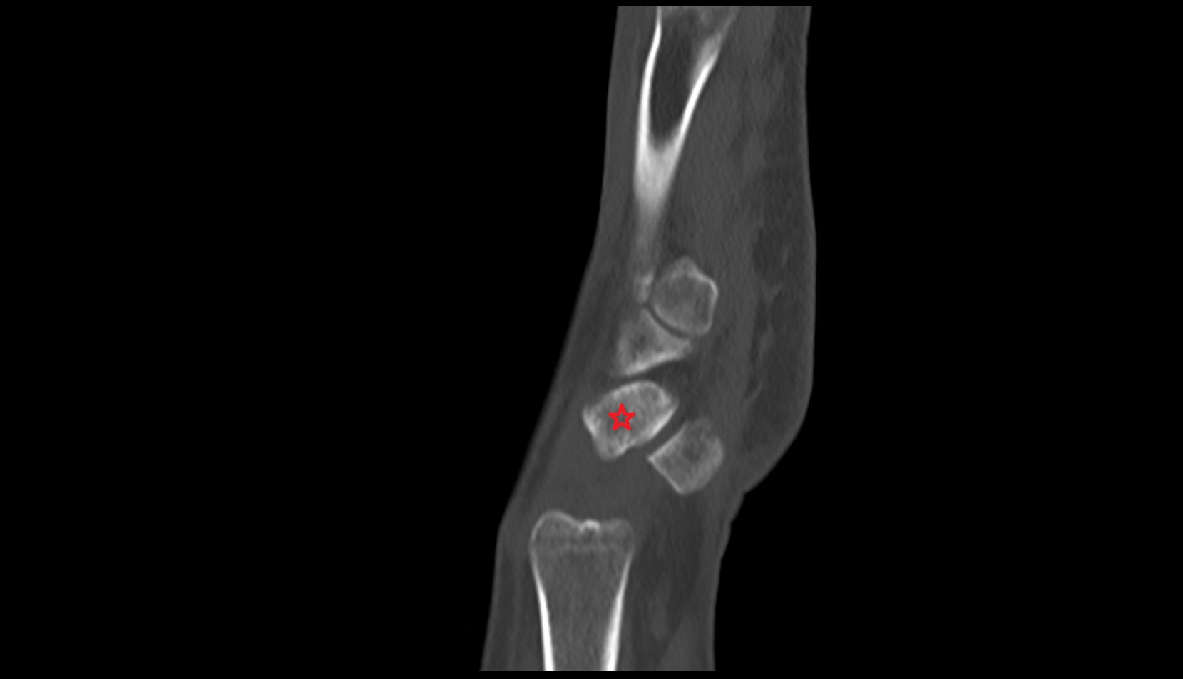 Triquetrum ct sag image