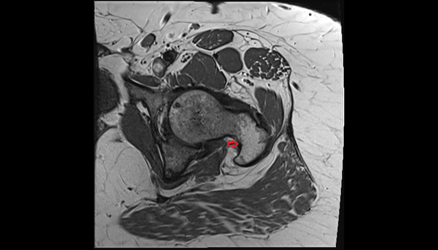Trochanteric fossa  MRI axial image-img-00000-00000