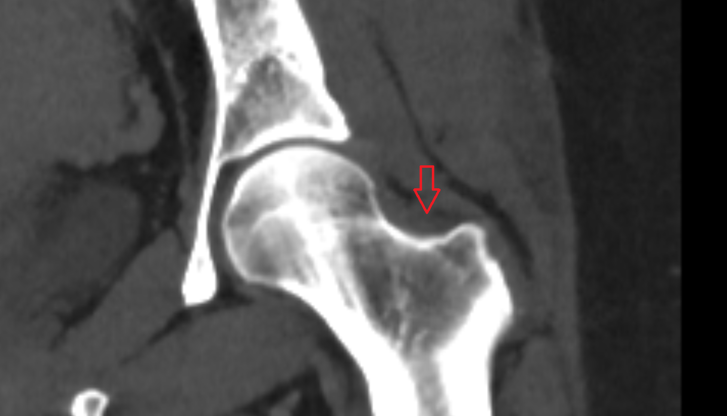 Trochanteric fossa ct  anatomy  Location and Imaging Appearance  -img-00000-00000