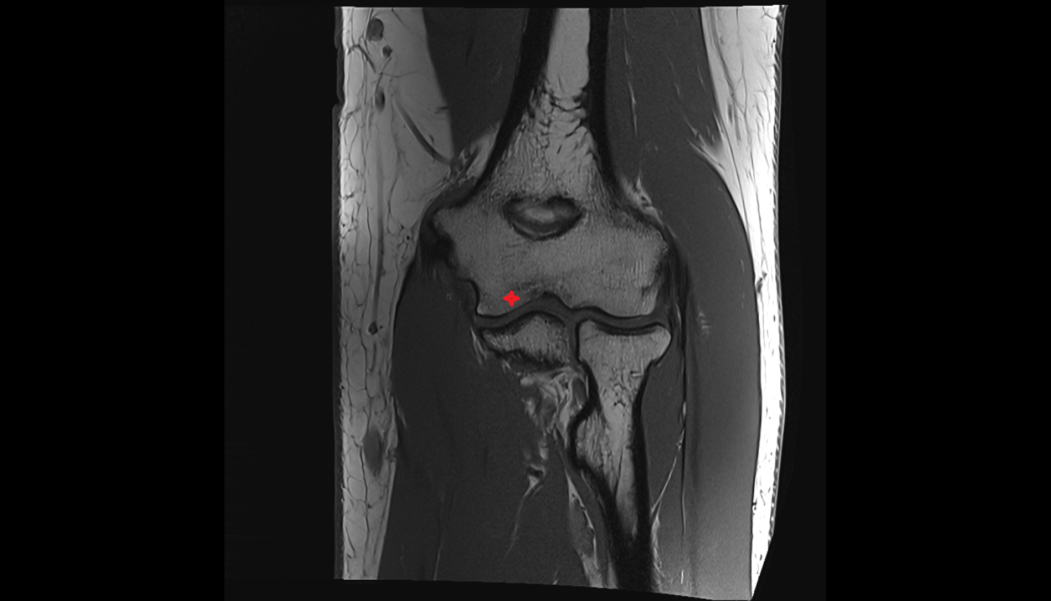 Trochlea of humerus coronal cross sectional anatomy 3T MRI AI enhanced radiology image -img-00000-00000