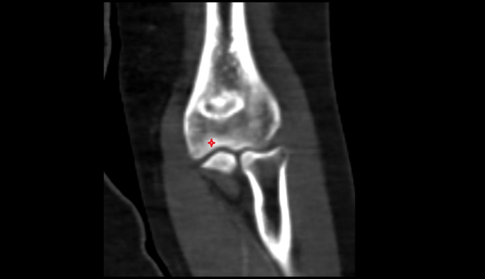 Trochlea of humerus ct coronal image