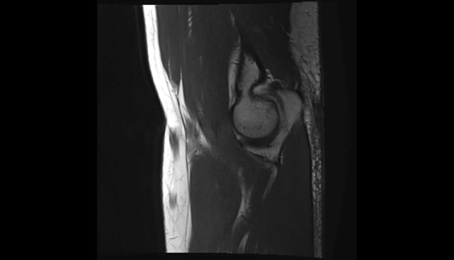 Trochlea of humerus  sag cross sectional anatomy 3T MRI AI enhanced radiology image -img-00000-00000