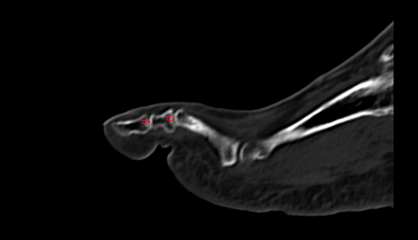 Trochlea of phalanx CT