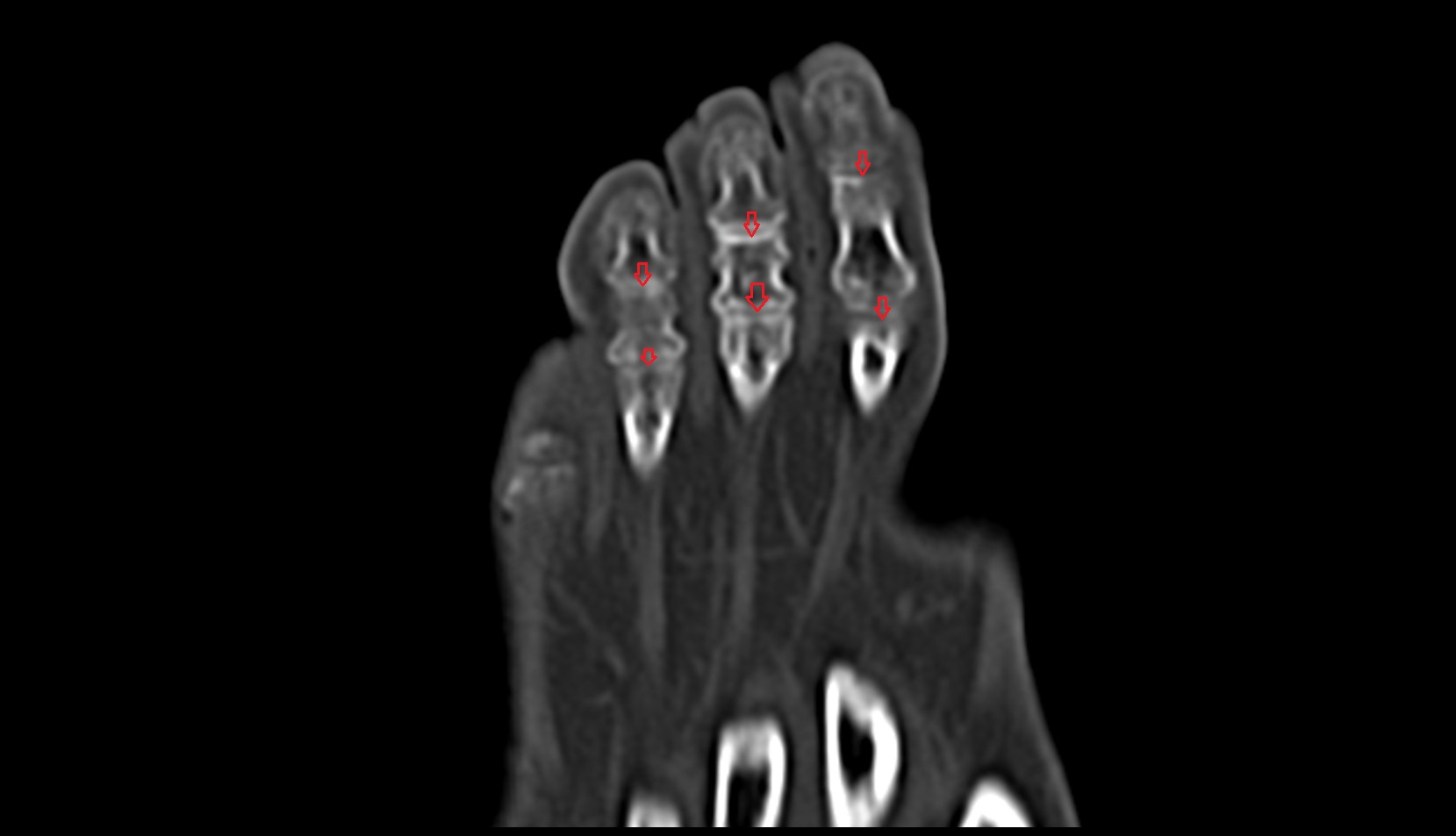 Trochlea of phalanx CT 1