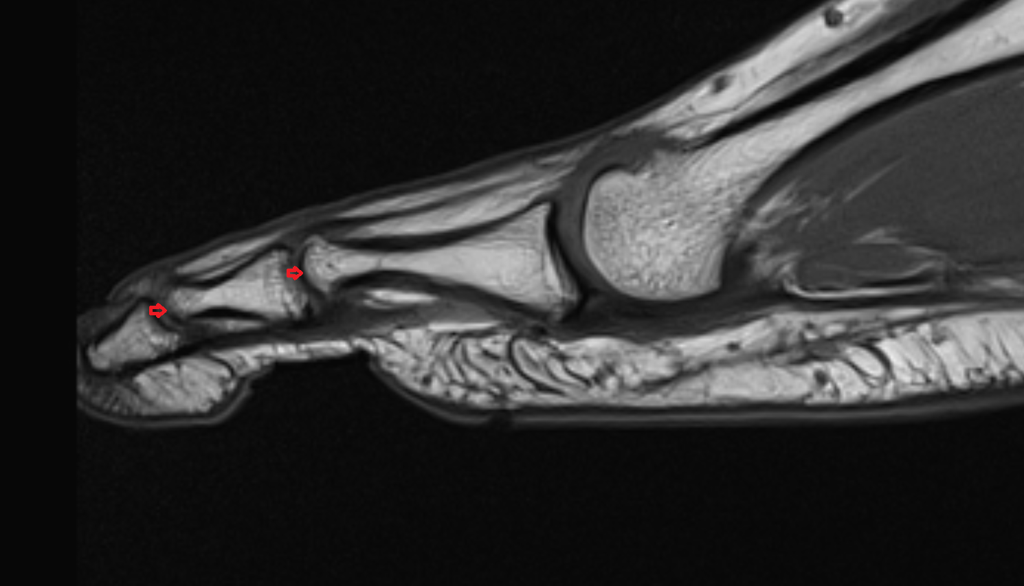 Trochlea of phalanx  mri  anatomy labelled image-img-00000-00000