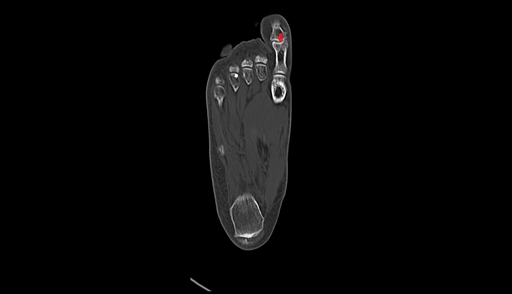 Trochlea of phalanx of great toe ct
