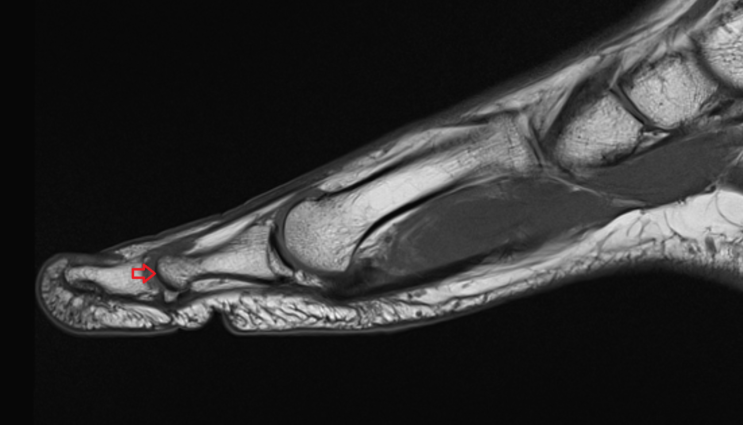 Trochlea of phalanx of great toe mri  anatomy labelled image-img-00000-00000