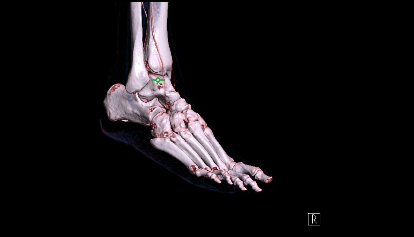 Trochlea of talus