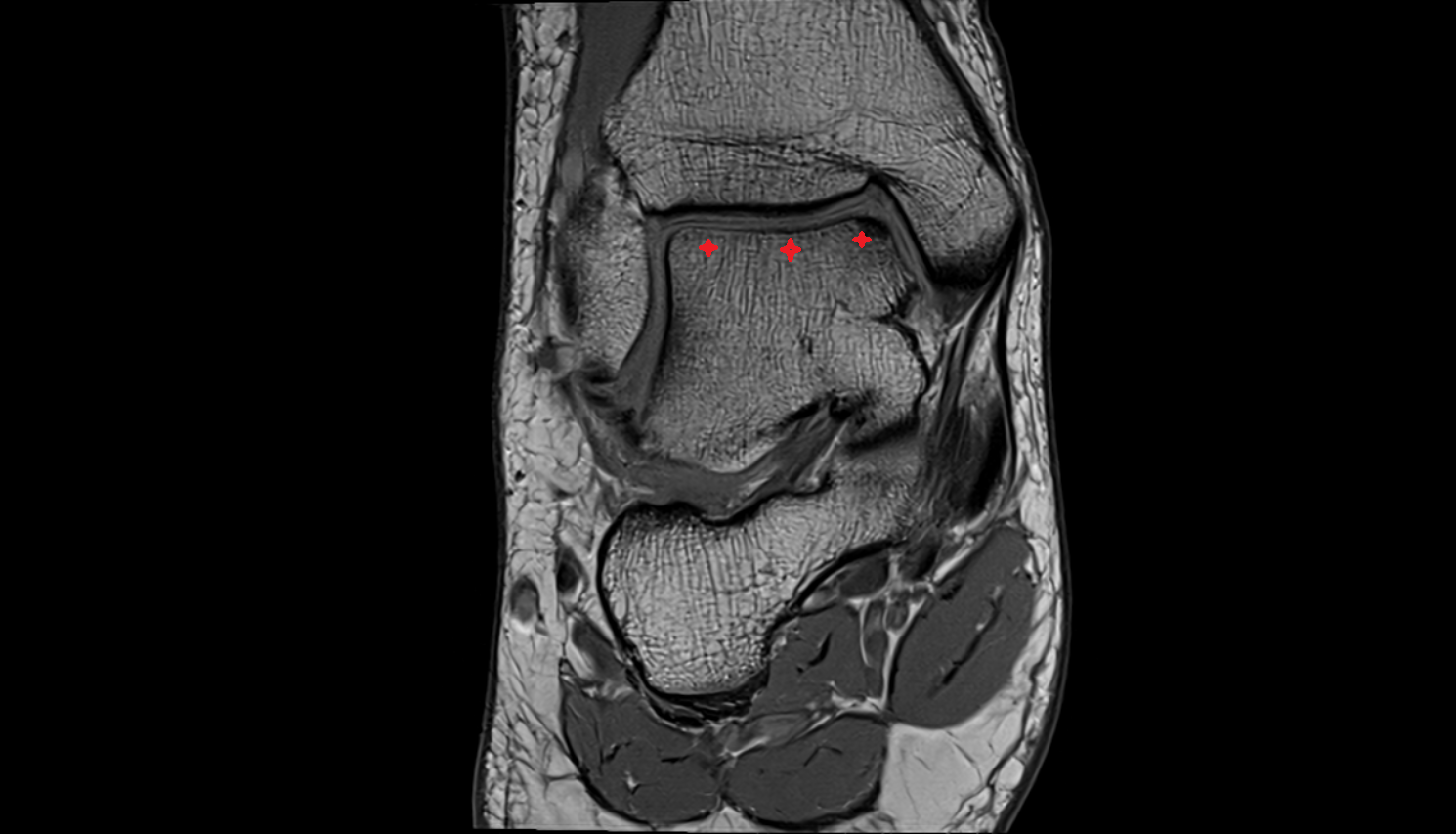 Trochlea of talus  mri  anatomy labelled image-img-00000-00000