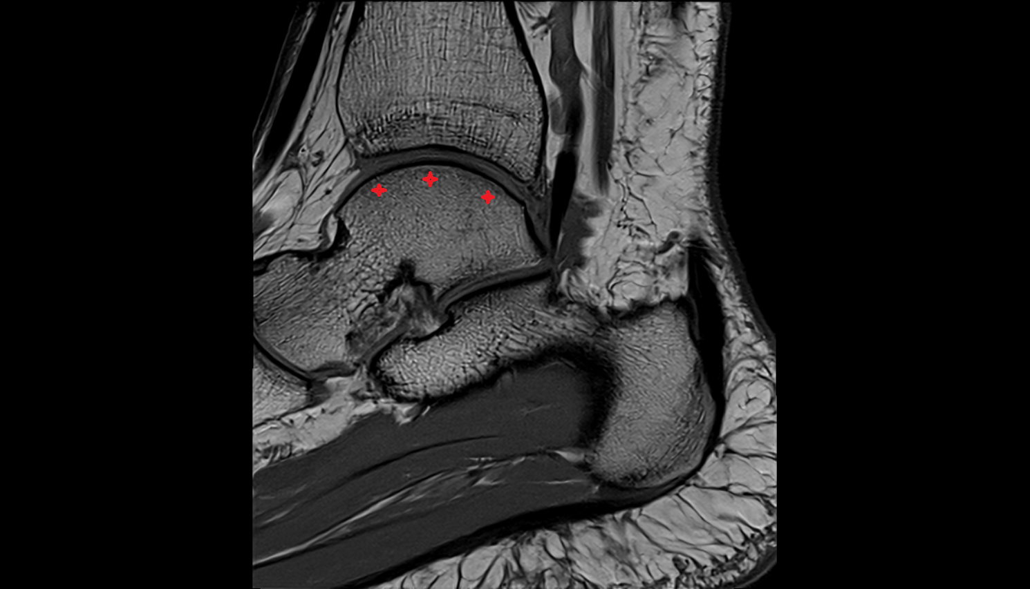 Trochlea of talus  mri  anatomy labelled image-img-00000-00000_00001