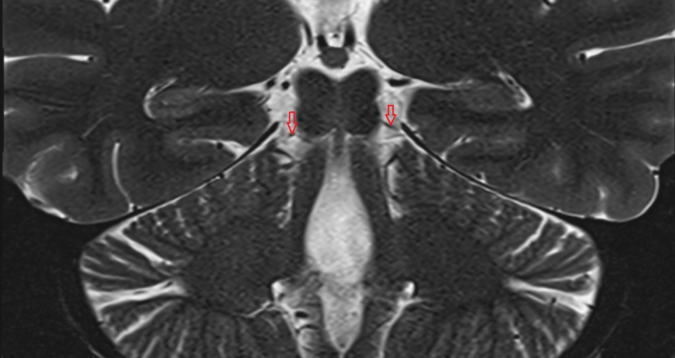 Trochlear Nerve (Cranial Nerve IV)  MRI coronal anatomy image -img-00001-00001