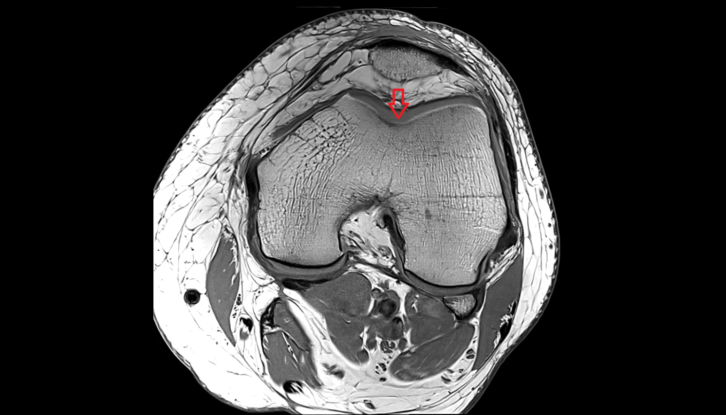 Trochlear groove axial  cross sectional anatomy 3T MRI AI enhanced  radiology  anatomy image-img-00000-00000