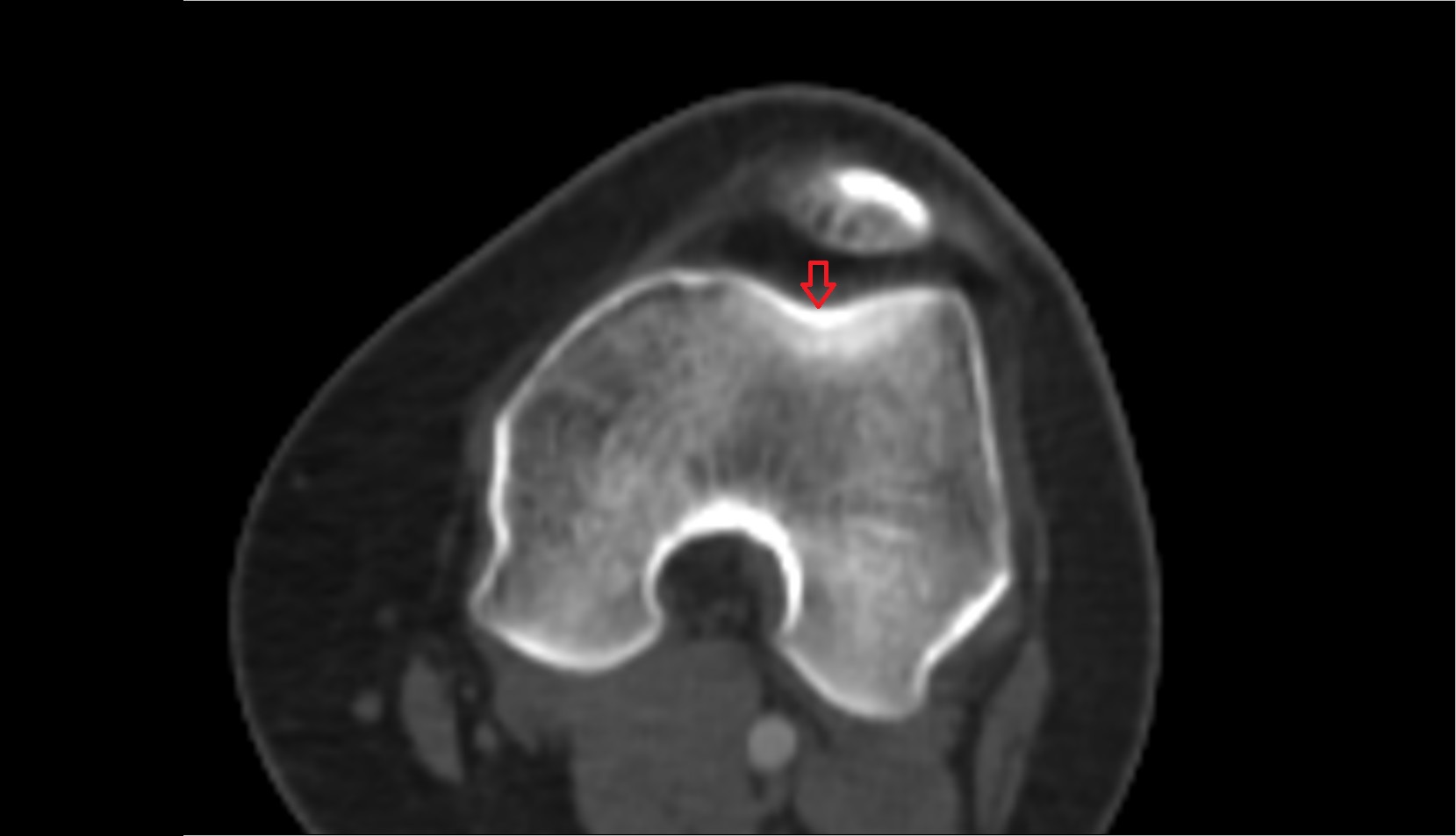 Trochlear groove ct axial image
