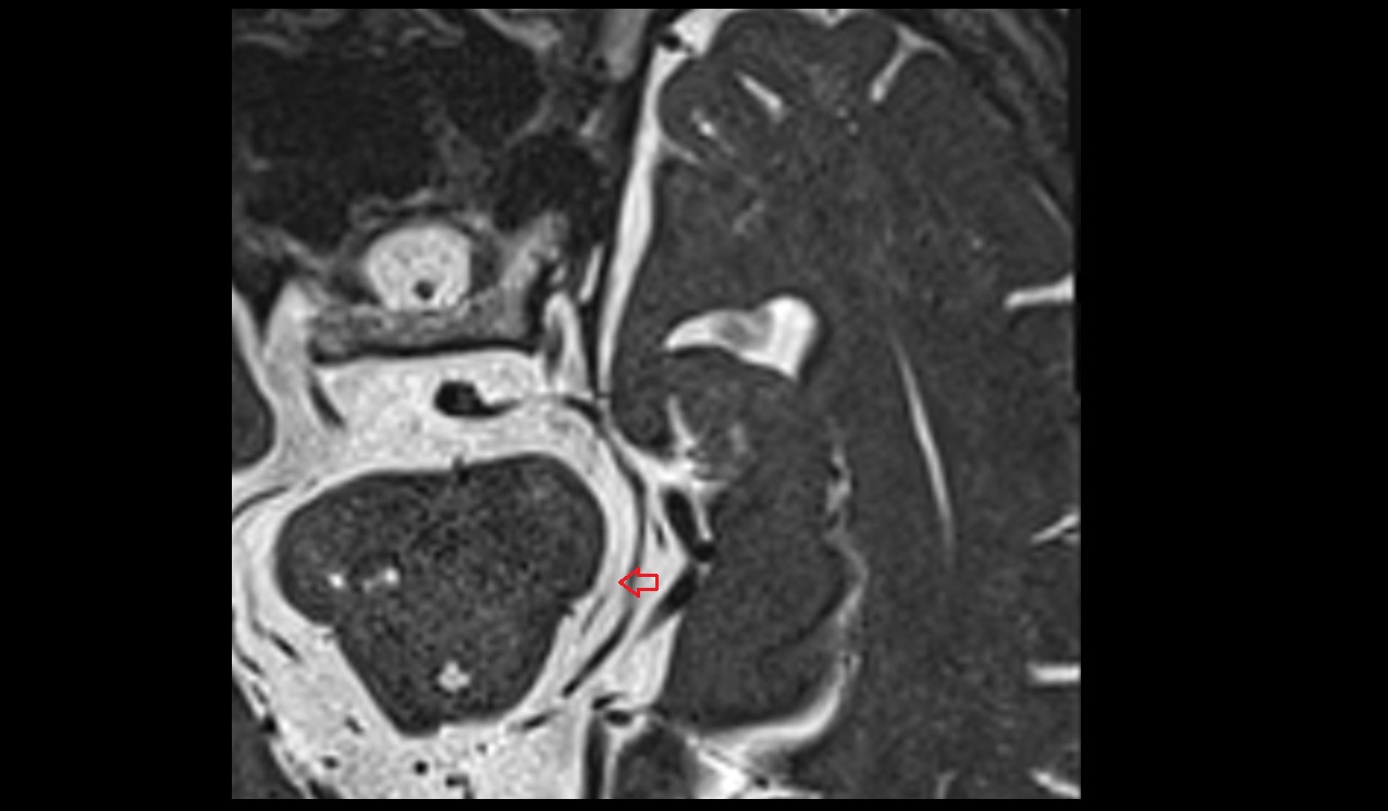 Trochlear nerve (Cranial nerve IV) 3T MRI axial image