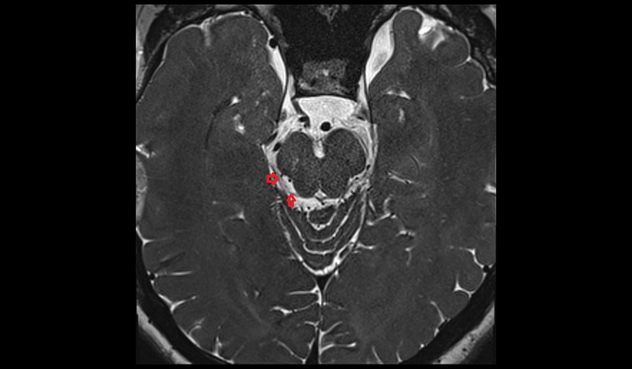 Trochlear nerve (Cranial nerve IV) 3T MRI axial image 1