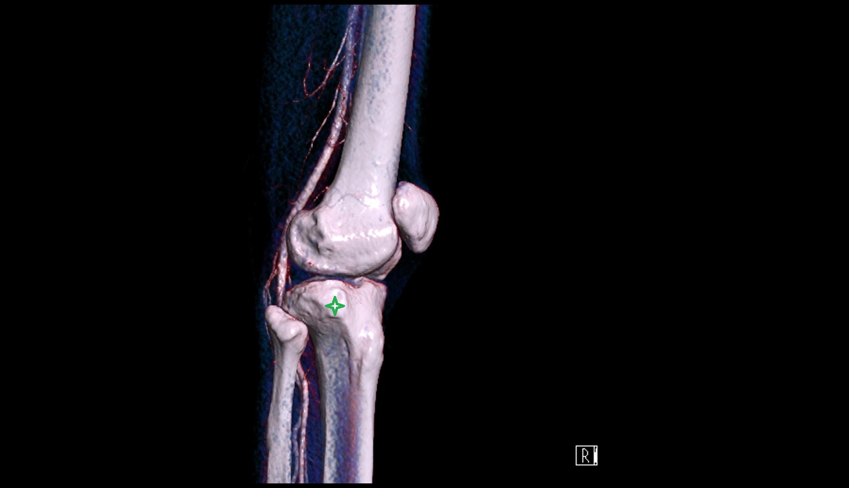 Tubercle of iliotibial tract 3d