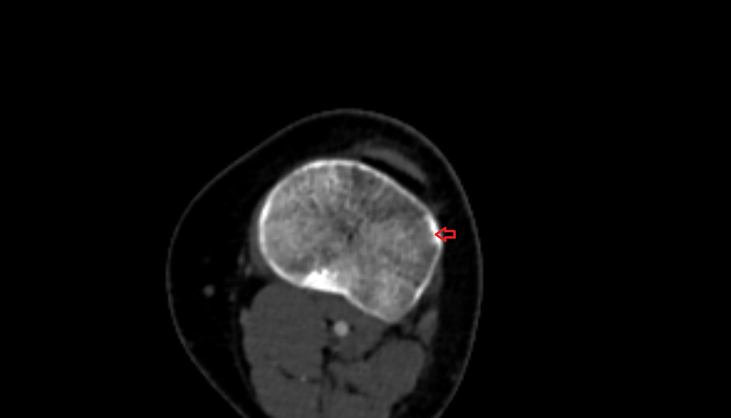 Tubercle of iliotibial tract  ct  anatomy labelled image-img-00000-00000