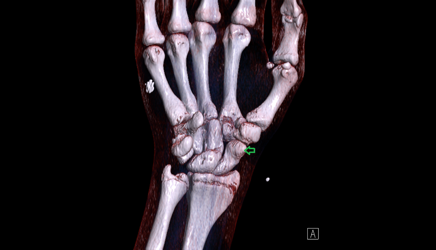 Tubercle of scaphoid bone 3d  coronal cross sectional anatomy 3T MRI AI enhanced radiology image-img-00000-00000