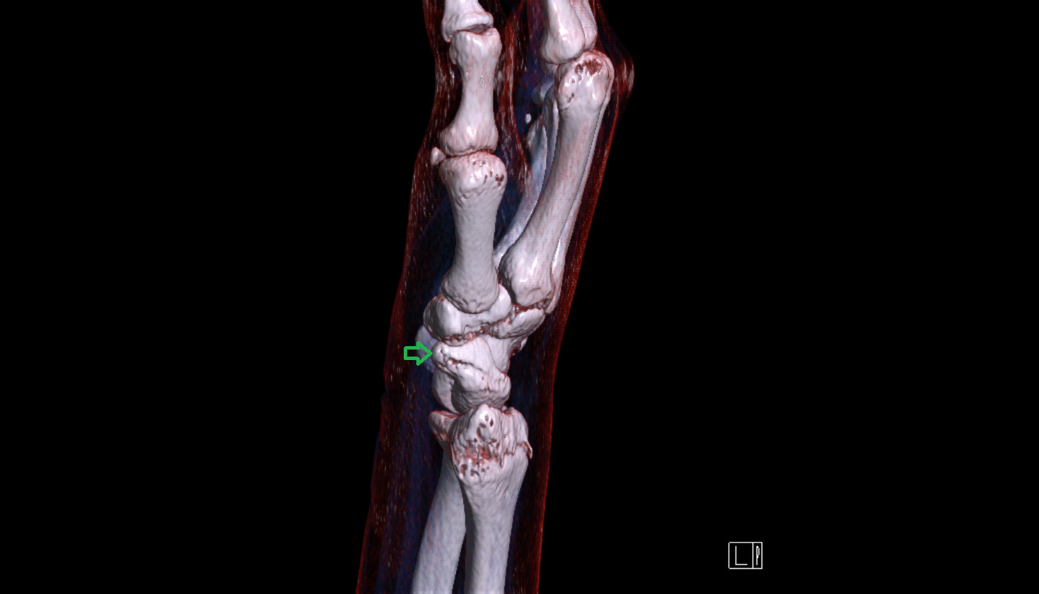 Tubercle of scaphoid bone 3d  coronal cross sectional anatomy 3T MRI AI enhanced radiology image-img-00000-00000_00001