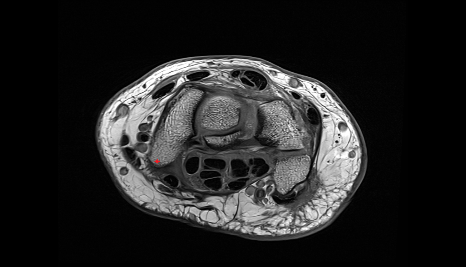 Tubercle of scaphoid bone axial cross sectional anatomy 3T MRI AI enhanced radiology image-img-00000-00000