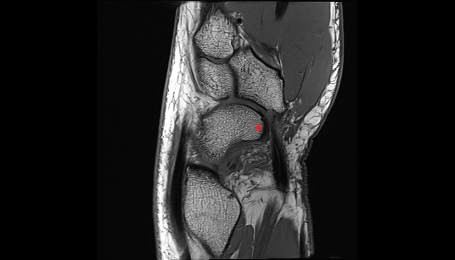 Tubercle of scaphoid bone mri  anatomy labelled image-img-00000-00000