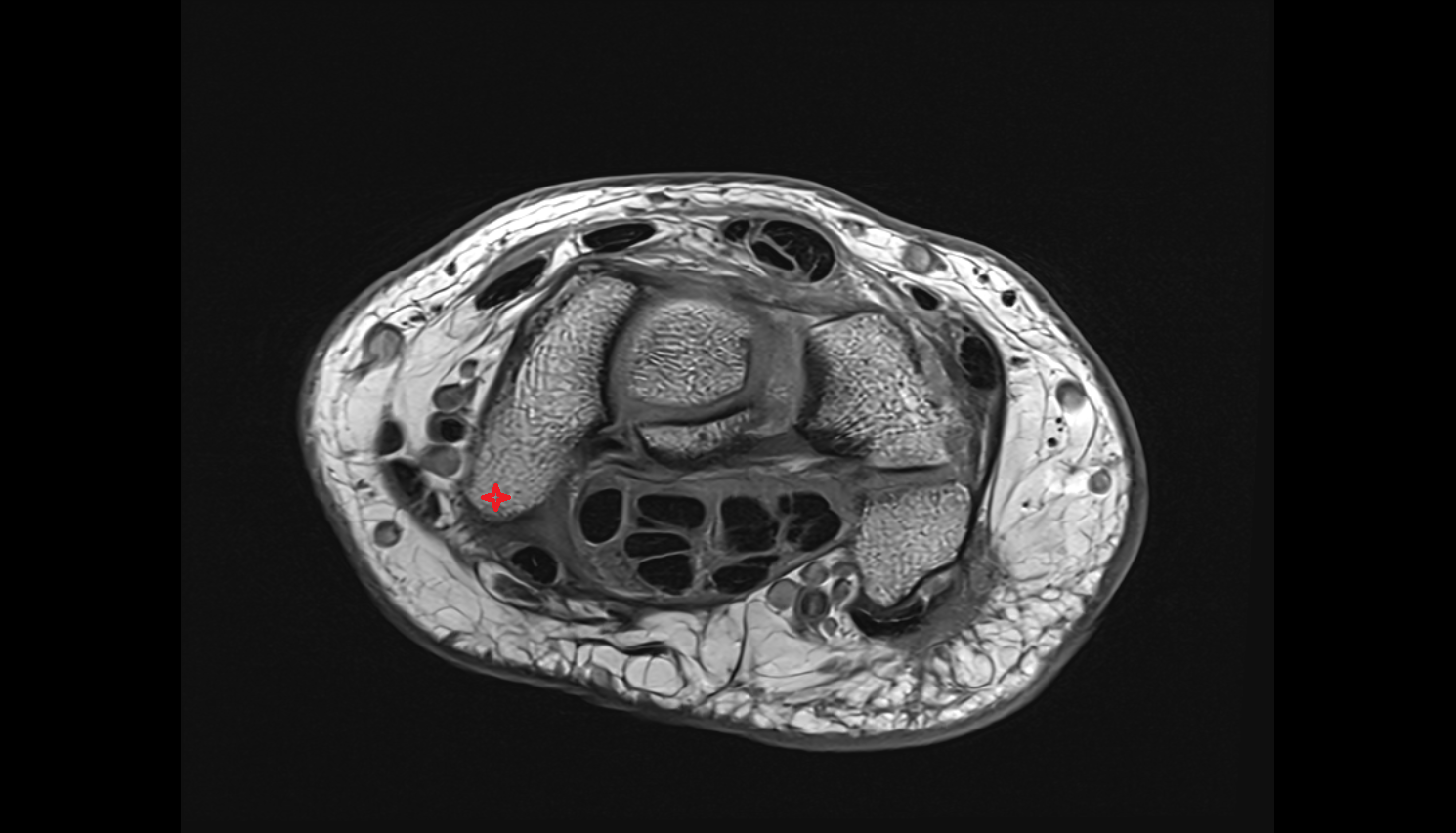 Tubercle of scaphoid bone mri  anatomy labelled image-img-00000-00000_00001