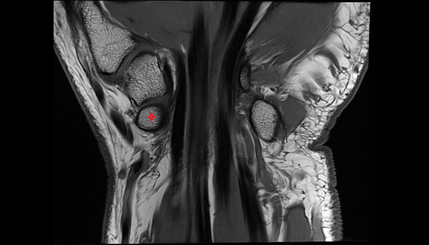 Tubercle of scaphoid bone mri  anatomy labelled image-img-00000-00000_00002