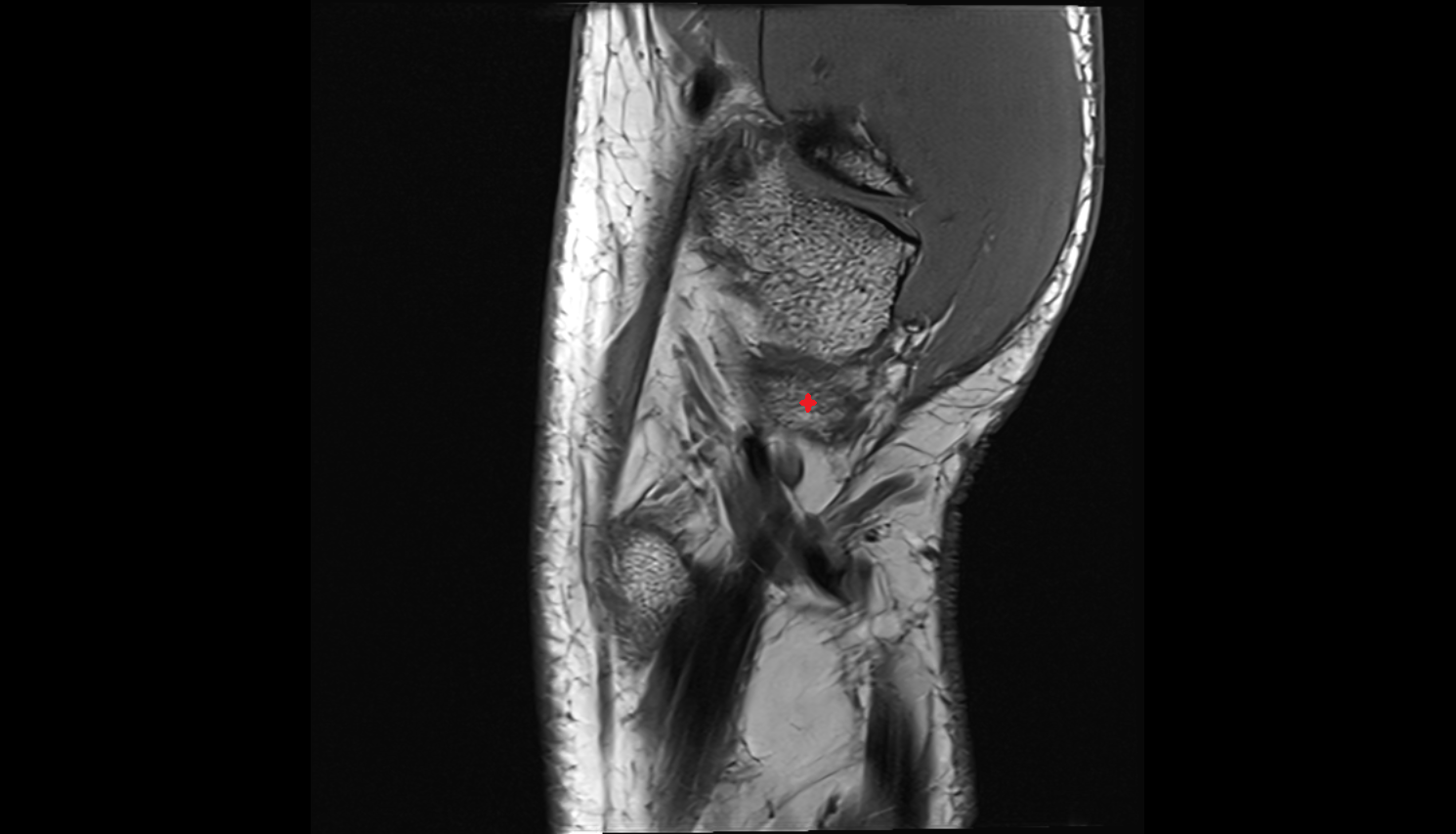 Tubercle of scaphoid bone sag cross sectional anatomy 3T MRI AI enhanced radiology image-img-00000-00000
