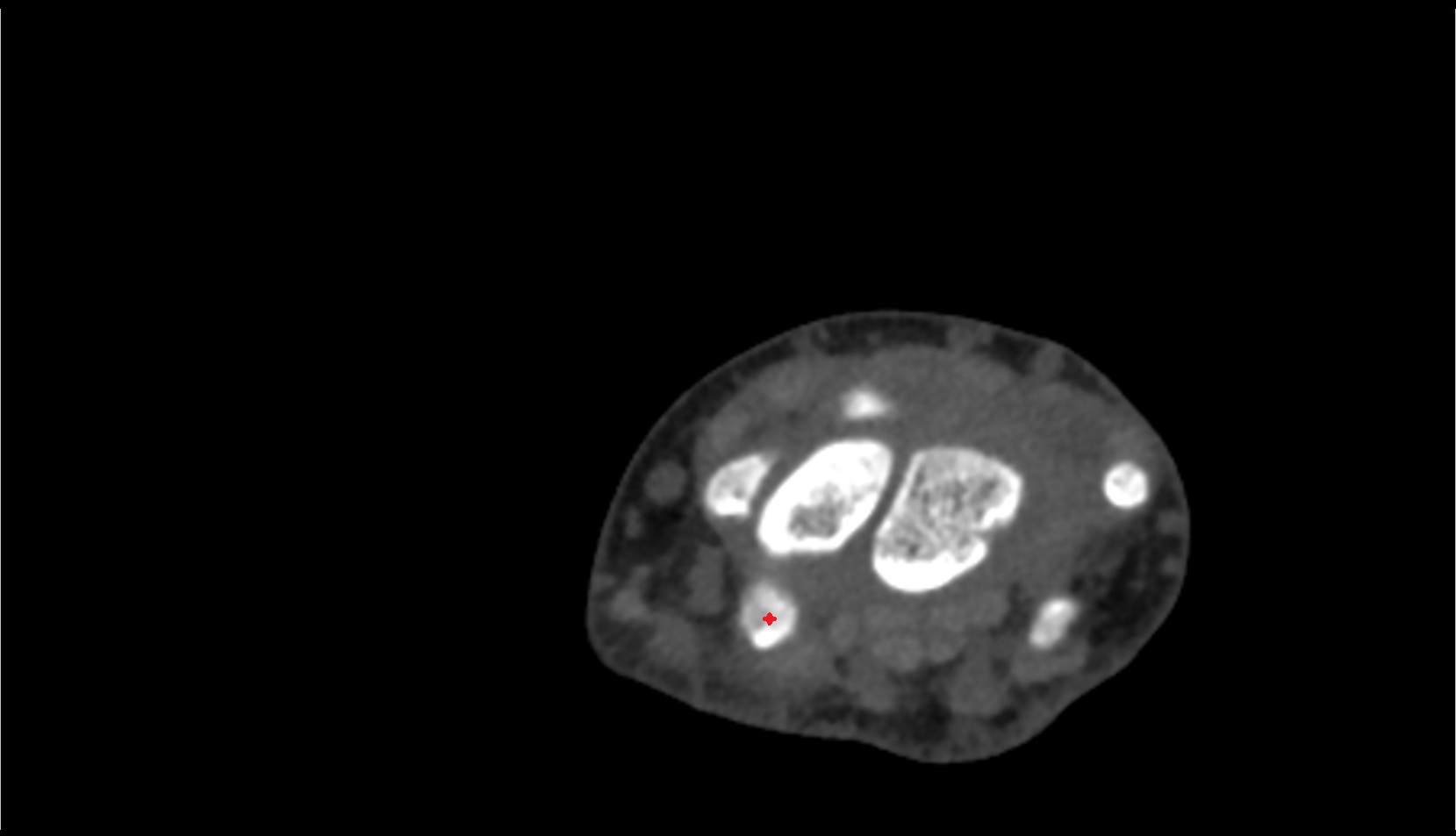 Tubercle of scaphoid ct axial image