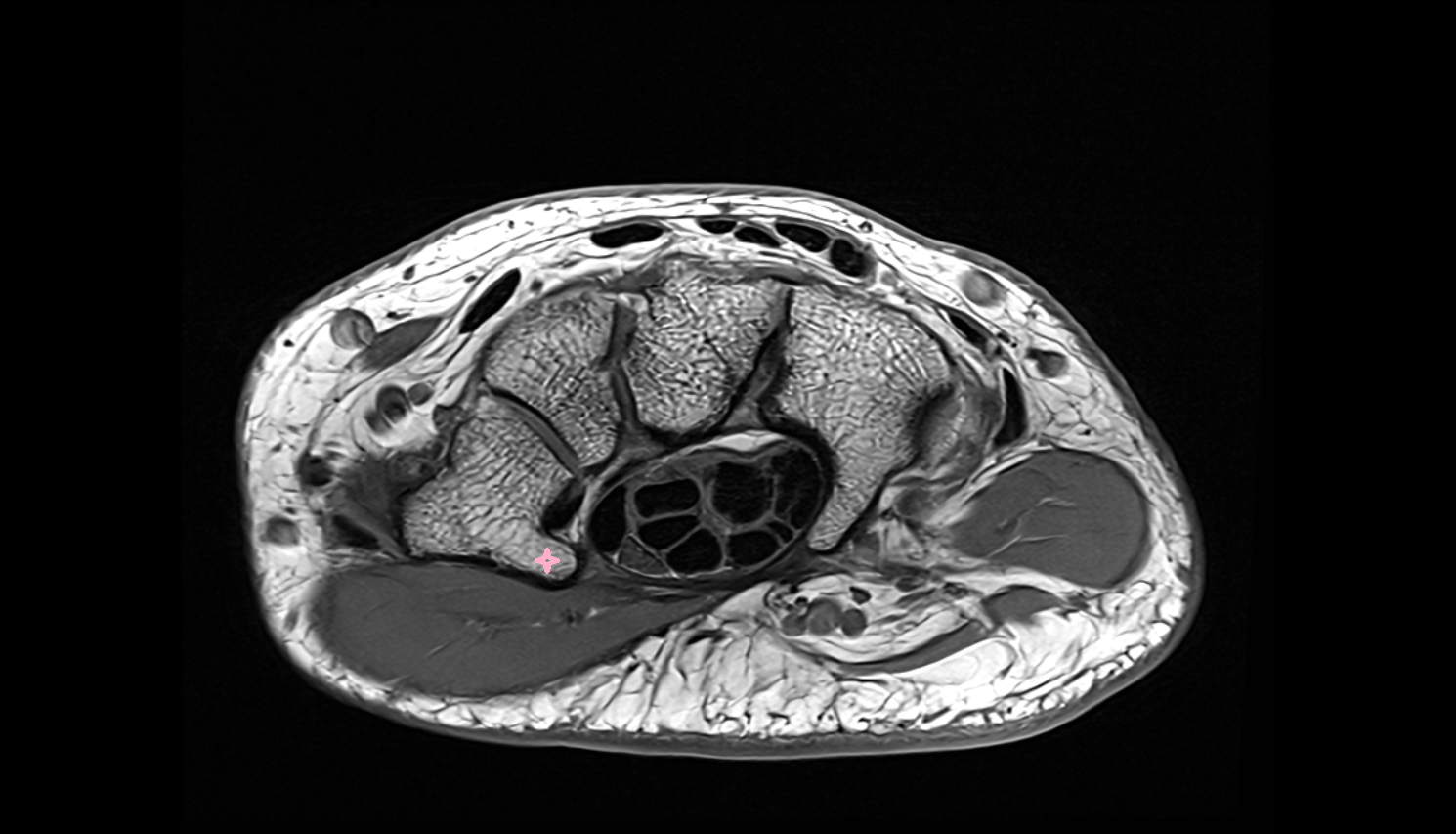 Tubercle of trapezium bone  bone axial cross sectional anatomy 3T MRI AI enhanced radiology image-img-00000-00000