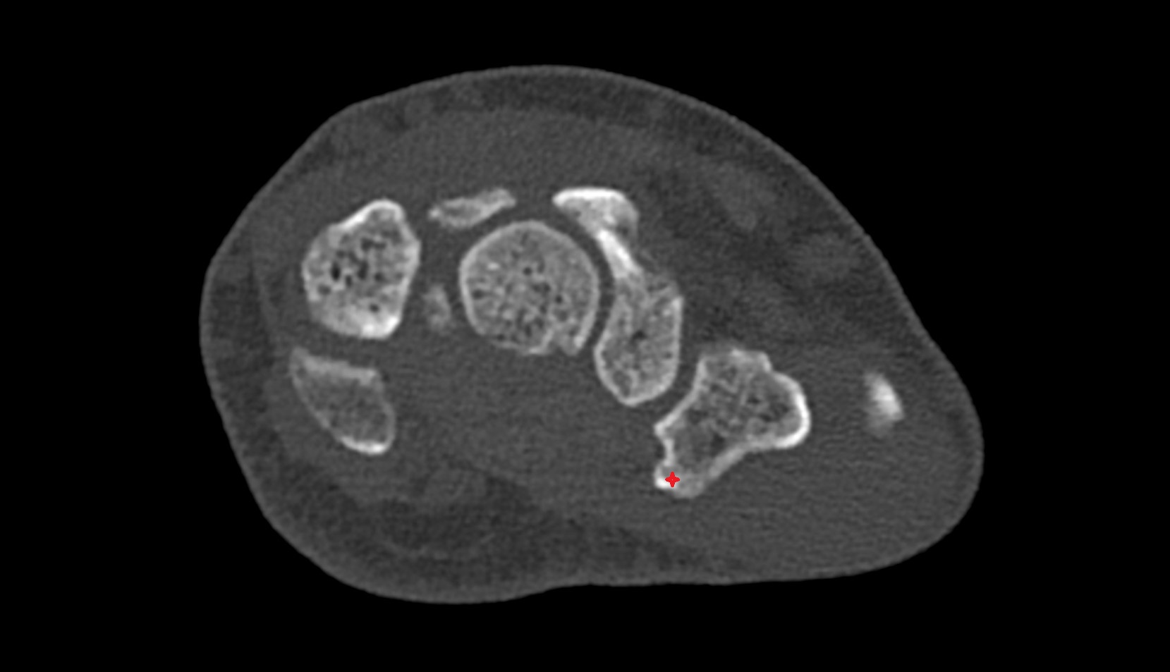 Tubercle of trapezium bone ct axial