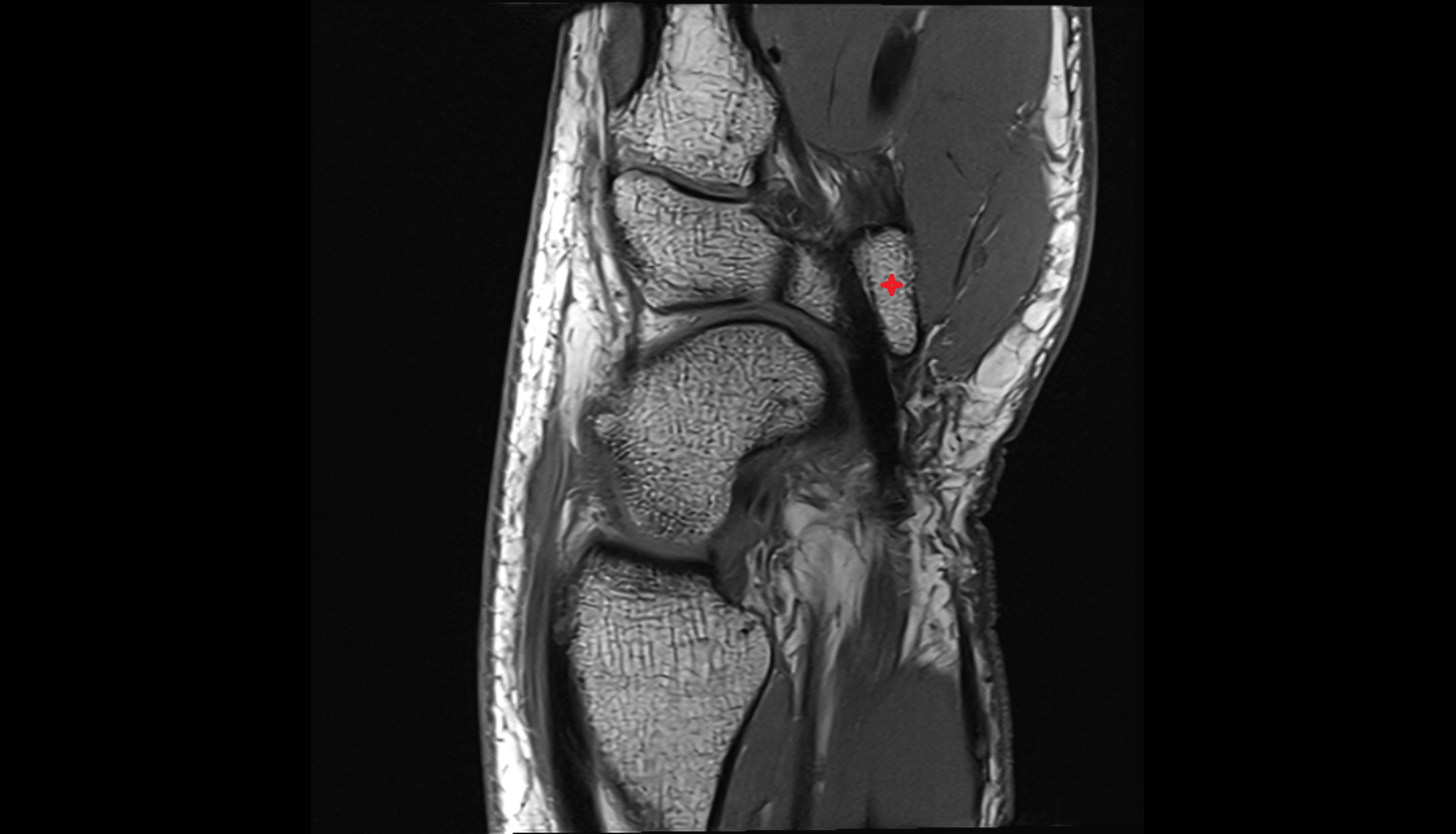 Tubercle of trapezium bone sag cross sectional anatomy 3T MRI AI enhanced radiology image-img-00000-00000