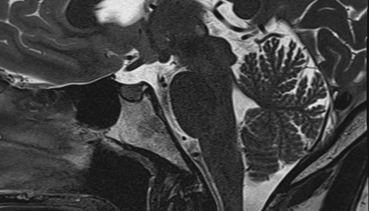 Tuber of Vermis (Lobule VII)  of Cerebellum mri sag  image -img-00000-00000