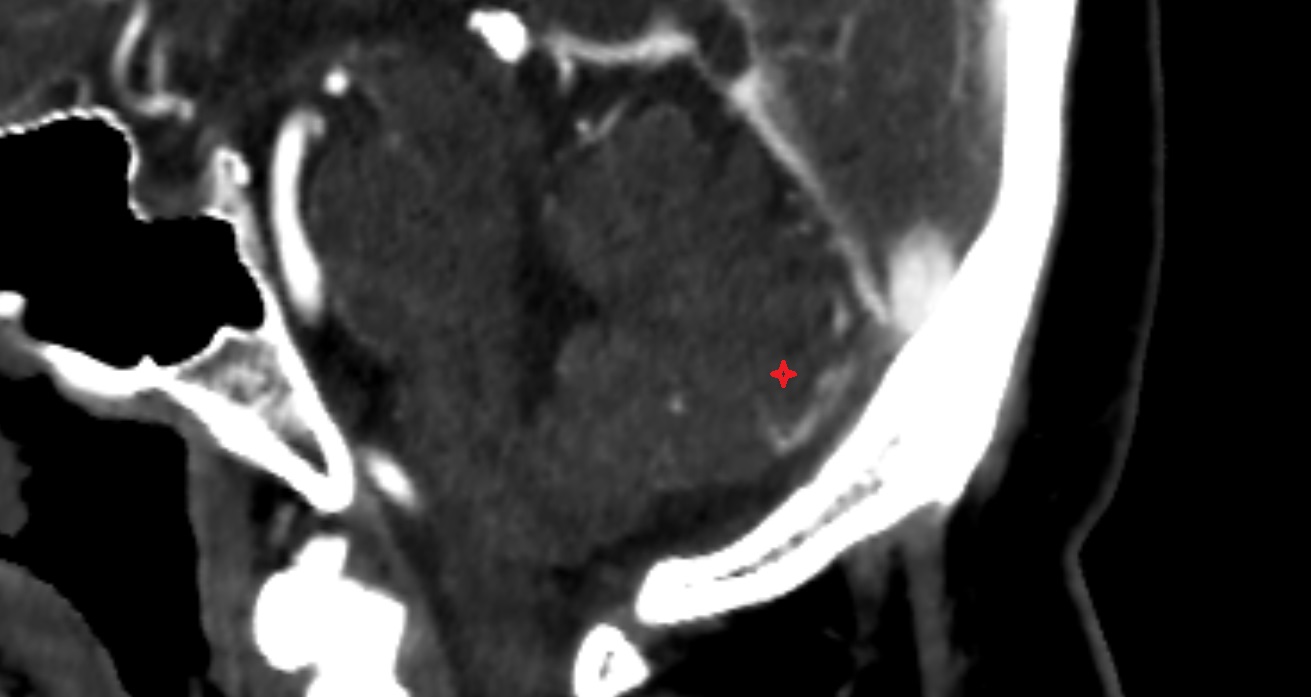 Tuber of vermis  CT axial anatomy image -img-00001-00001