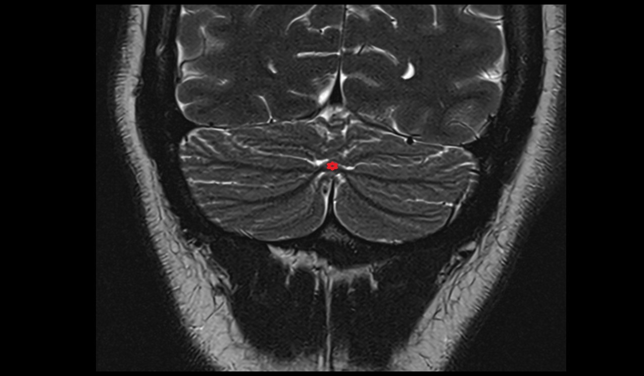 Tuber of vermis mri 3t coronal image