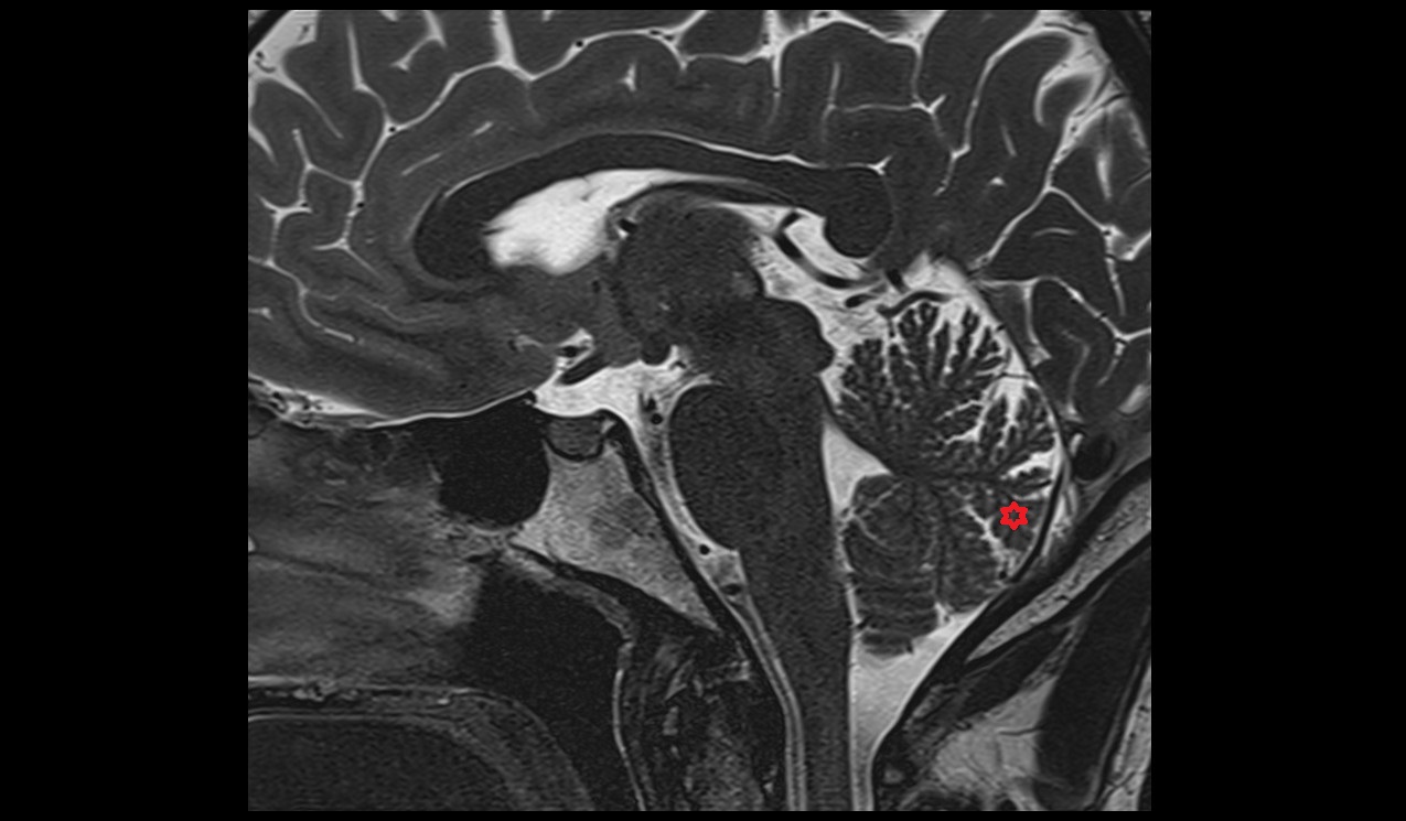 Tuber of vermis mri 3t sagittal image