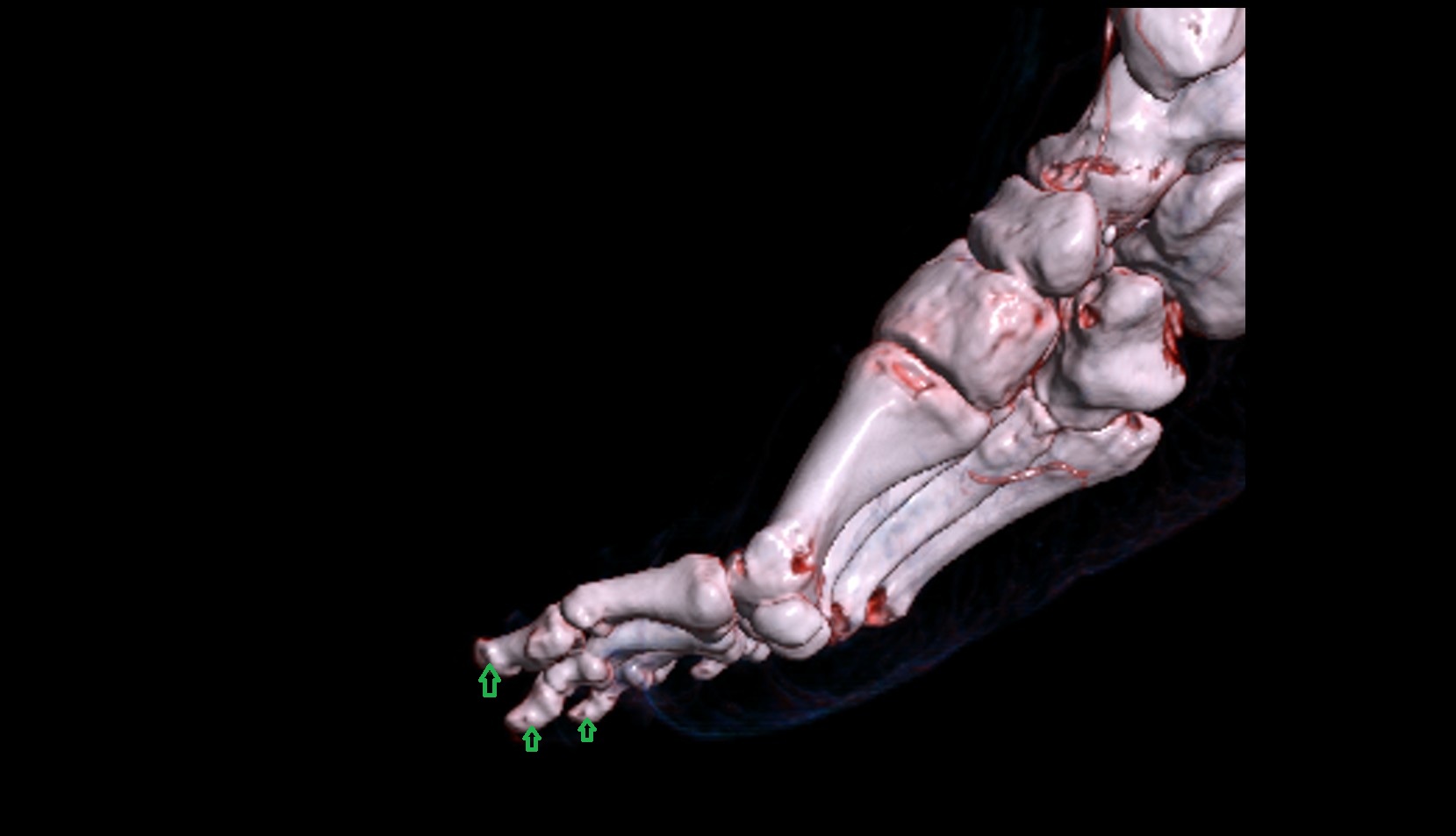 Tuberosity of Distal Phalanx of Foot 3D